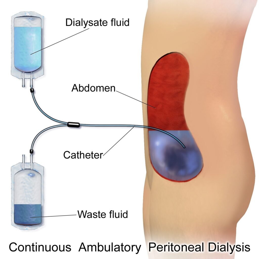 Ilustrasi dialisis peritoneal (CAPD)