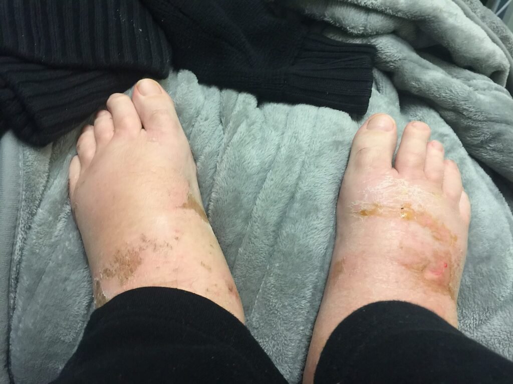 Kedua kaki bengkak karena penumpukan cairan (edema)