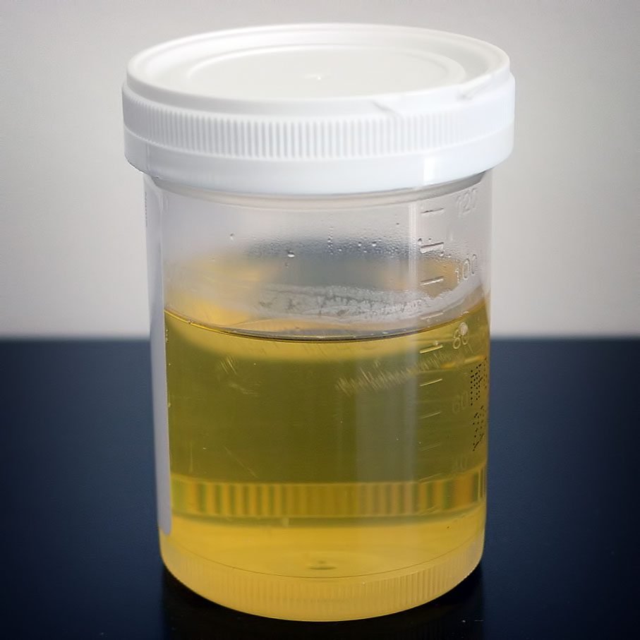 Contoh urine dalam wadah sampel untuk pemeriksaan albumin urine (UACR)