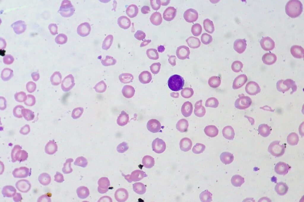 Sediaan apus darah anemia defisiensi besi, sel darah merah tampak kecil dan pucat di bawah mikroskop