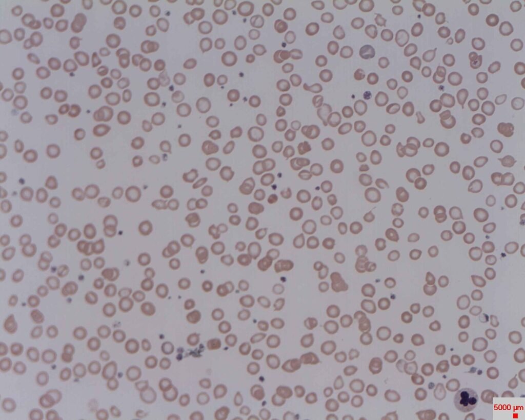 Sediaan apus darah pada anemia kekurangan zat besi, sel darah merah tampak kecil dan pucat