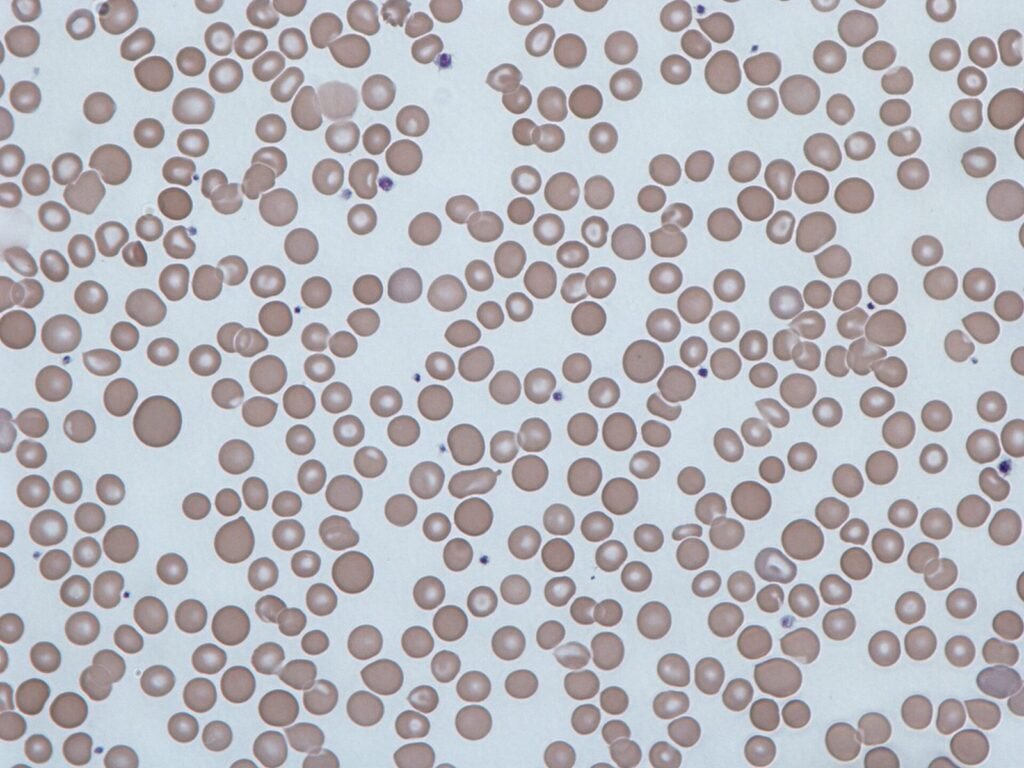 Sel darah merah manusia di bawah mikroskop dengan ukuran yang berbeda-beda (anisositosis)