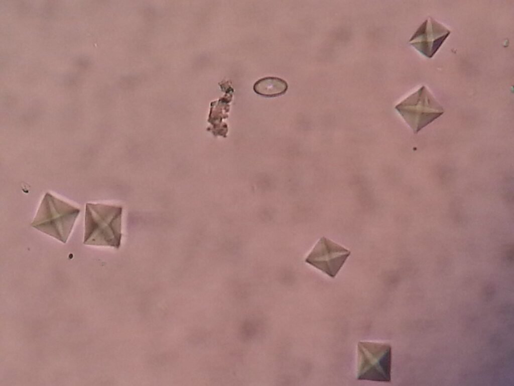 Kristal kalsium oksalat berbentuk seperti amplop kecil pada pemeriksaan mikroskop urine