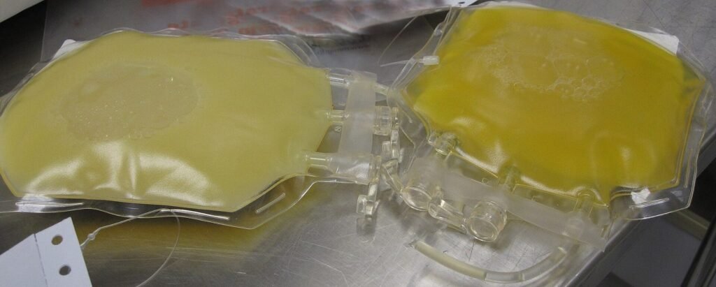 Dua kantong plasma darah, yang kiri tampak keruh seperti susu karena kadar lemak darah tinggi